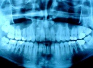 X-rays: A Necessity For Your Oral Health [VIDEO]